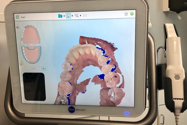 3D iTero Scanner - Kenneth Myers DDS