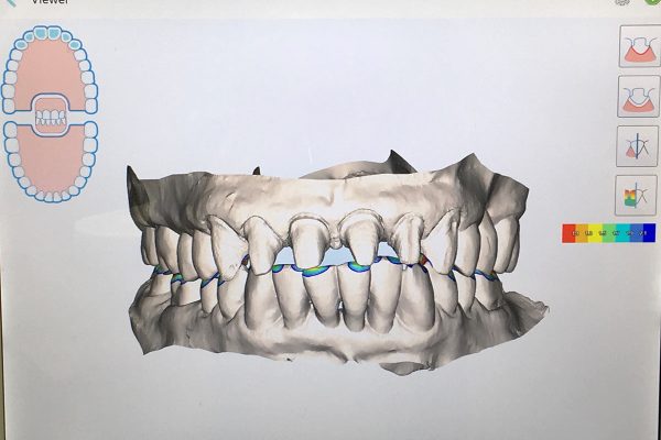 3D iTero Scanner - Kenneth Myers DDS